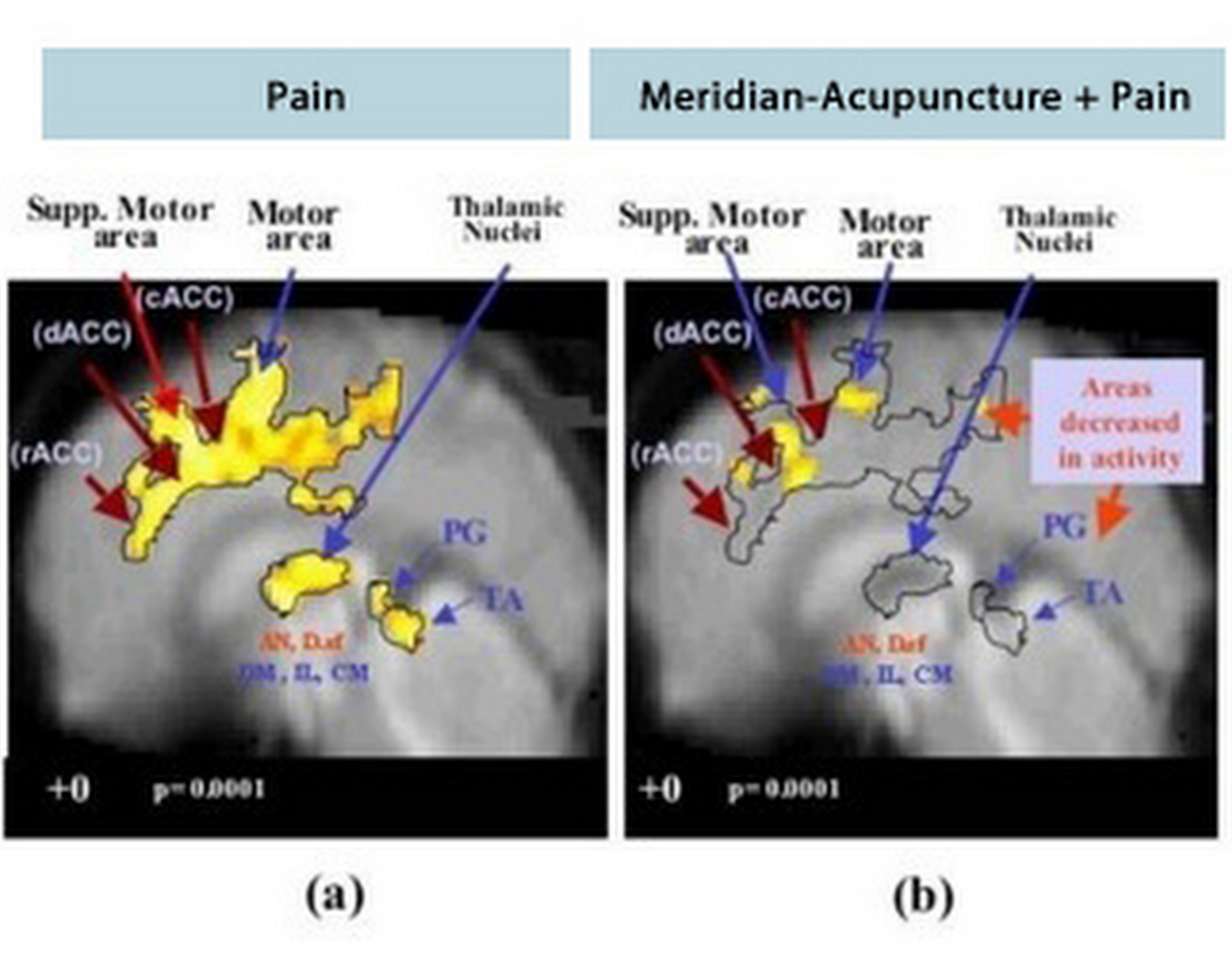 Brain Pain vs Acupuncture